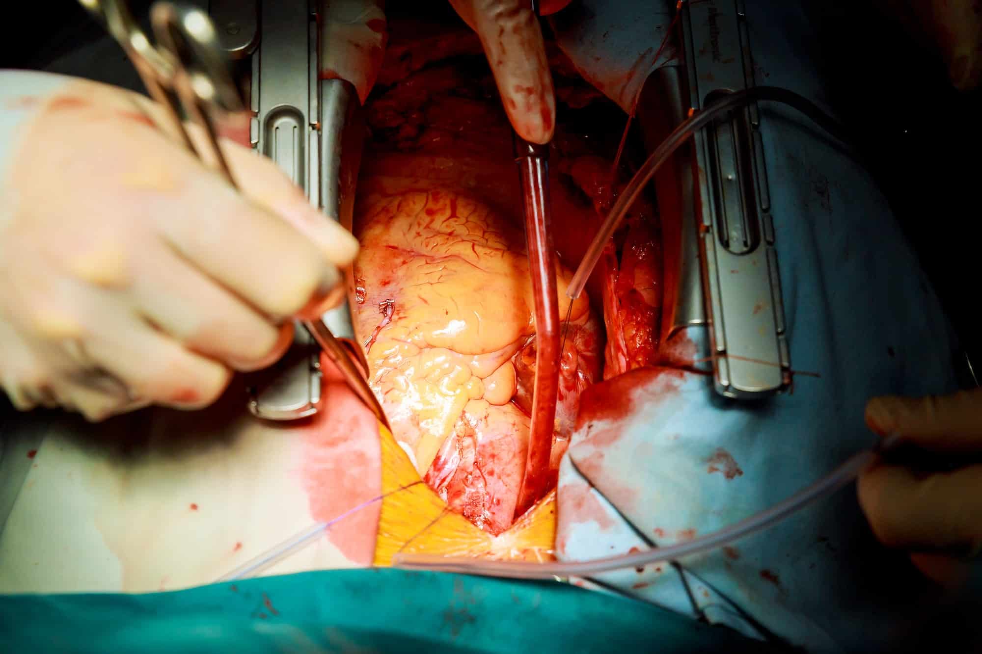 Human heart during cardiac surgery transplantation