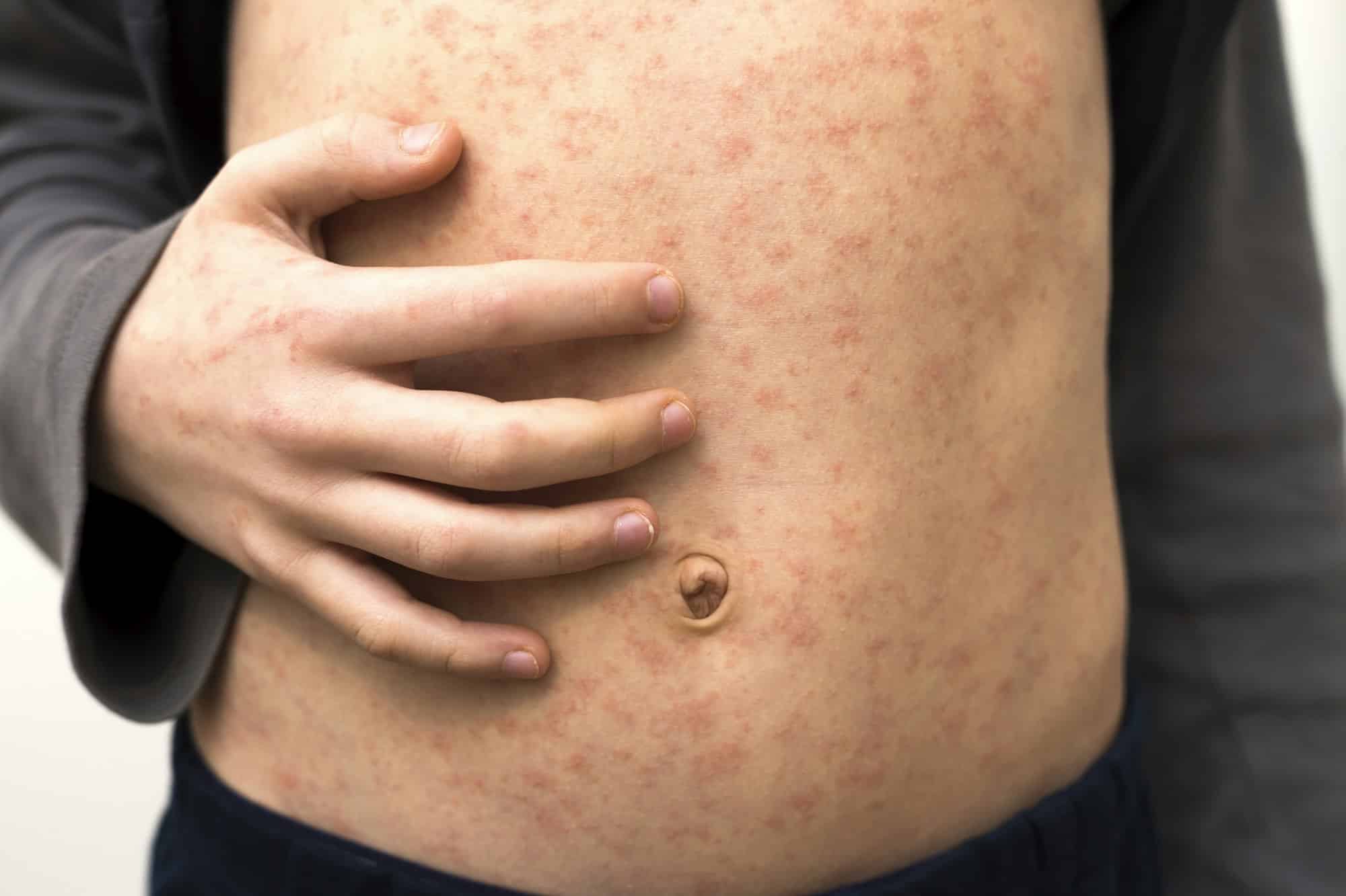 Sick child body, stomach with red rush spots from measles or chicken pox